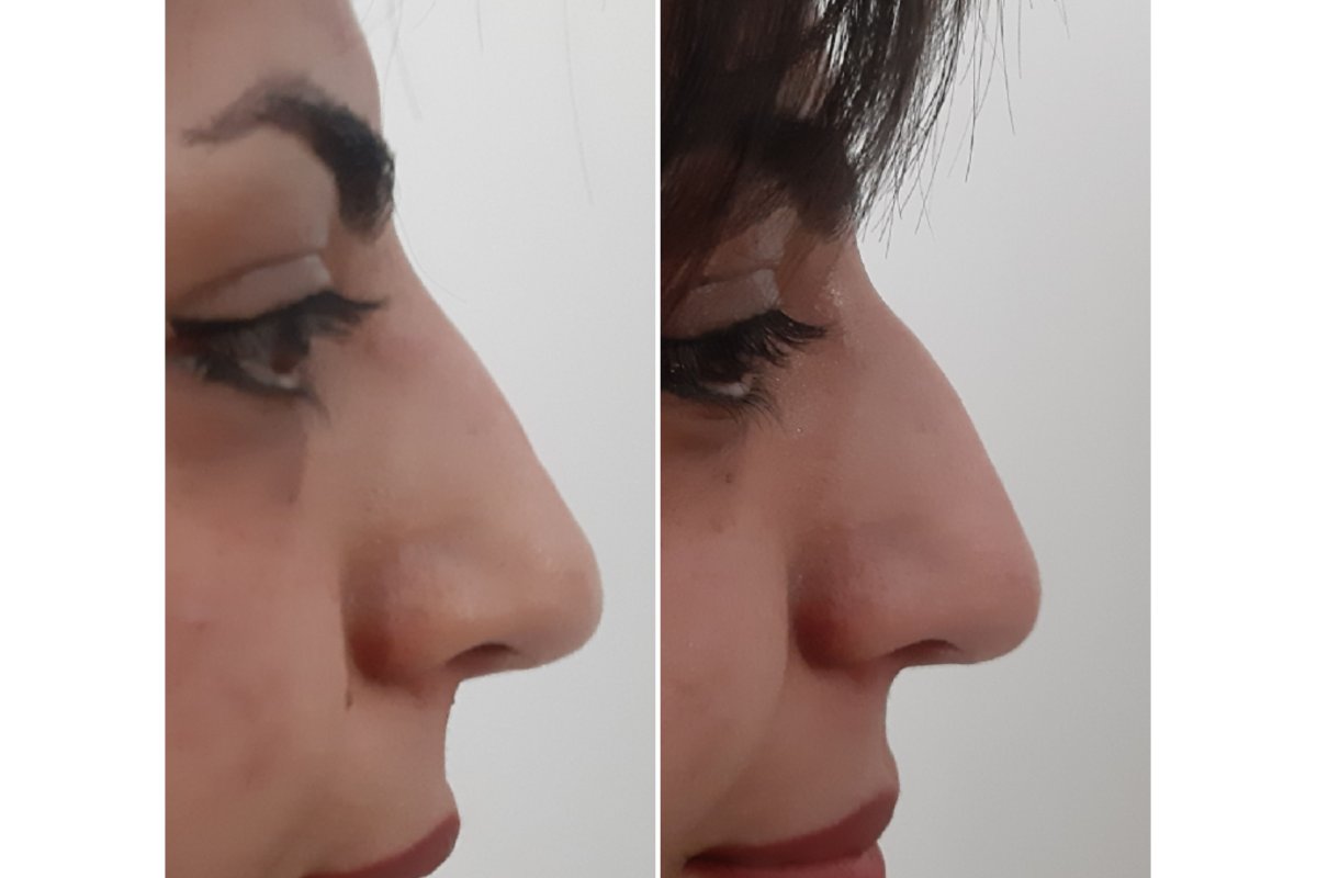 Before and after nose filler injections Before and after nose filler injections