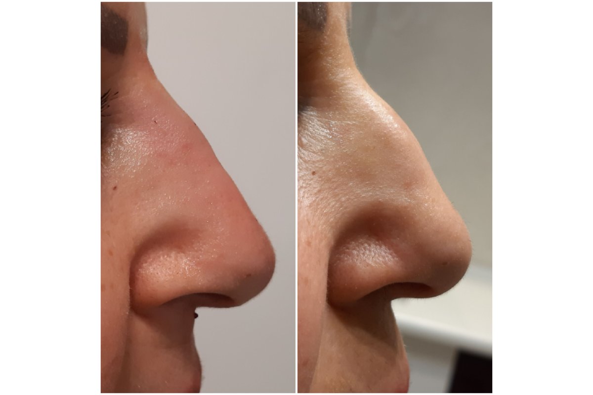 Nose Filler Before and After: What Results Can You Really Expect?