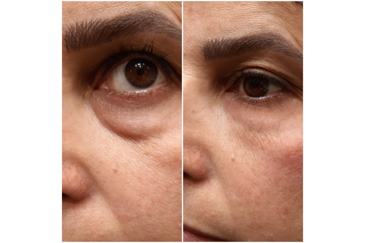 Before and after under-eye filler injections Before and after under-eye filler injections