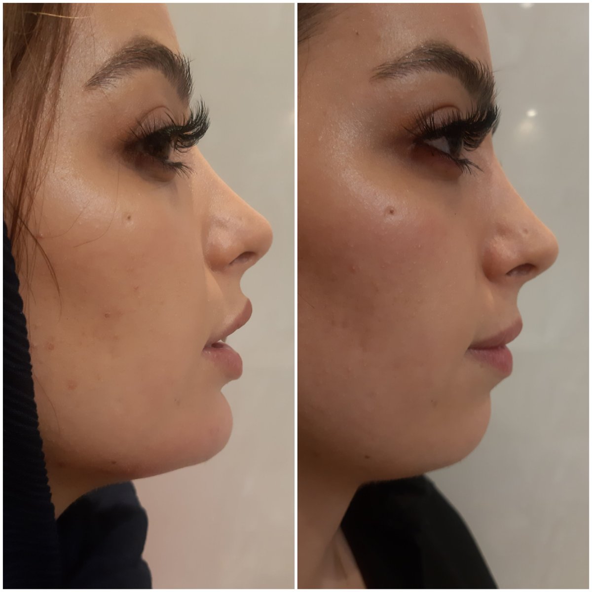 Before and after chin filler injection