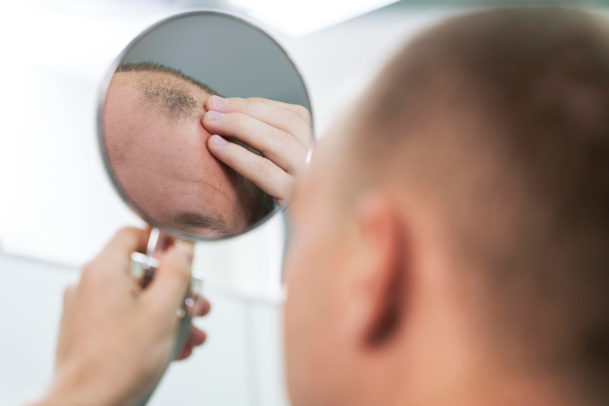 Hair-Thinning Consultation in Whitby: What Factors May Shape a PRP or Mesotherapy Plan?