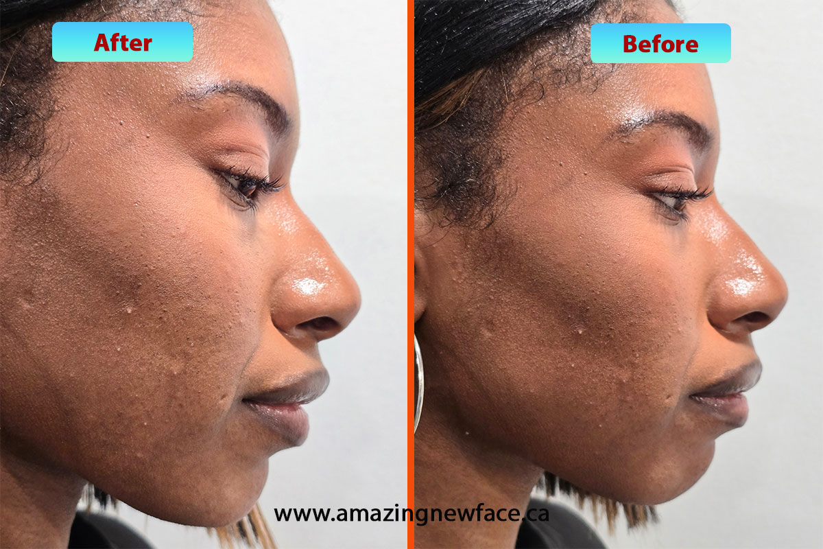 Before and after chin filler injection