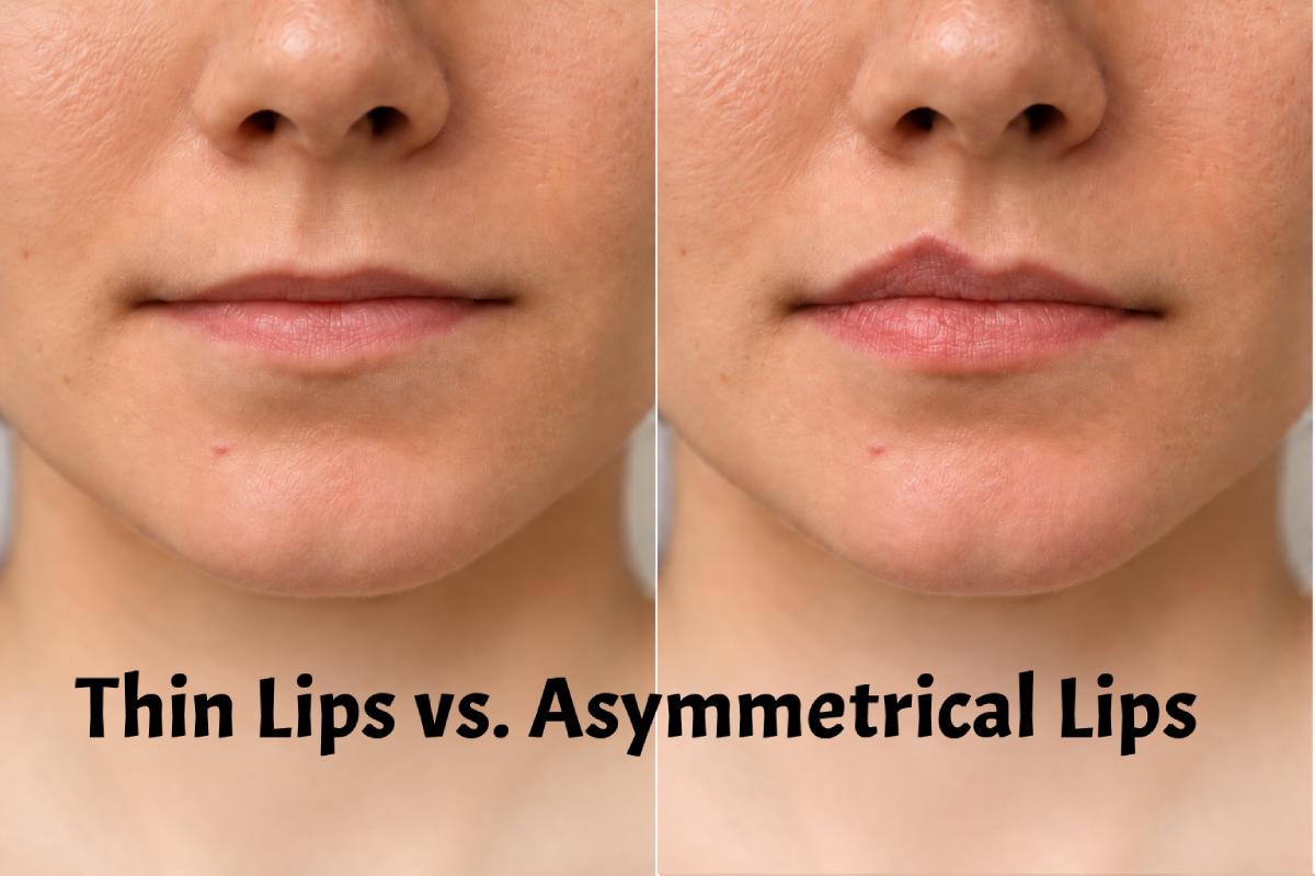 Thin Lips vs. Asymmetrical Lips: Why Your Lip Filler Consultation Matters
