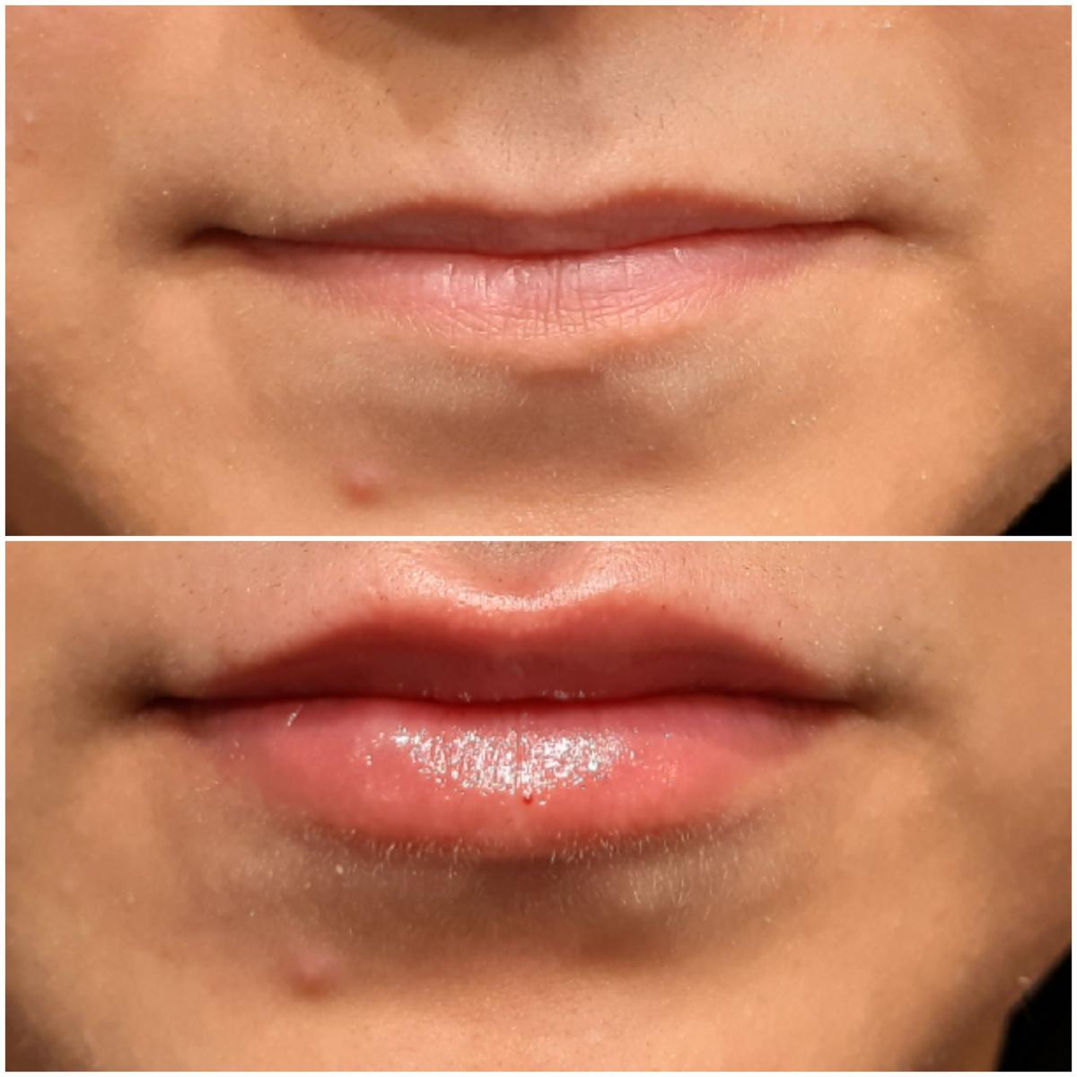 Lip Filler Injections At Amazing New Face Lip Filler Injections At Amazing New Face