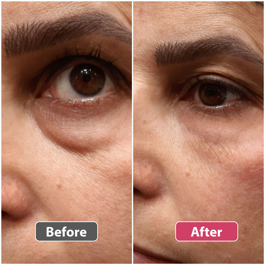 Before and after under-eye filler injections