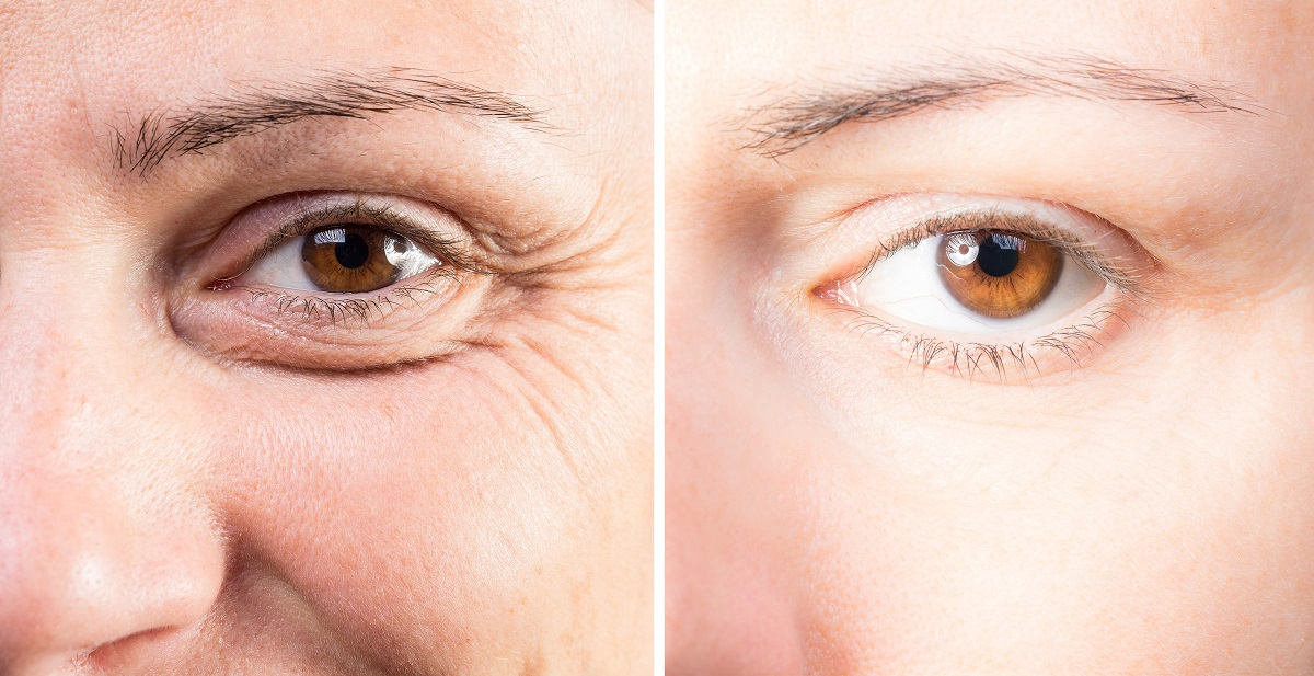 Crows feet correction