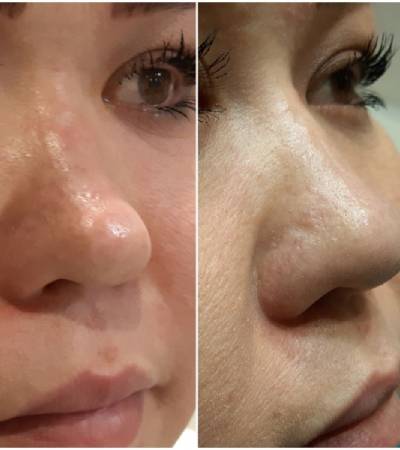 Nose deformity correction