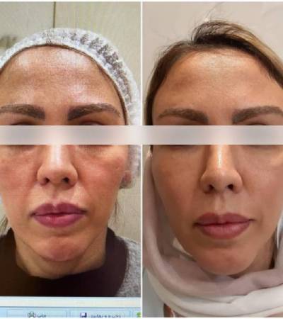 Cheek augmentation